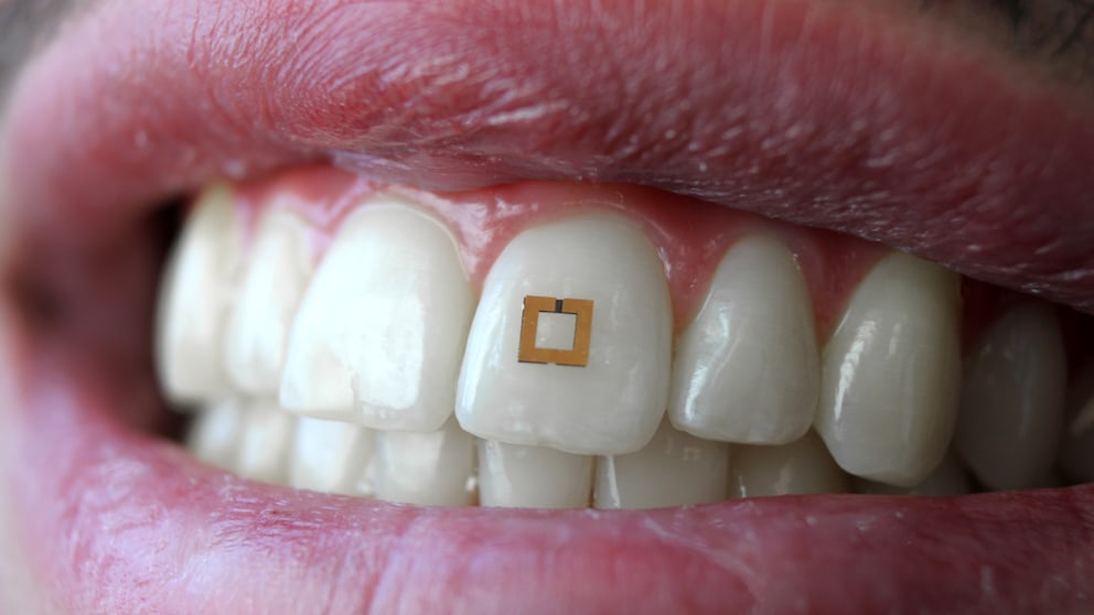 Bioanalyse-Chip auf einem Zahn