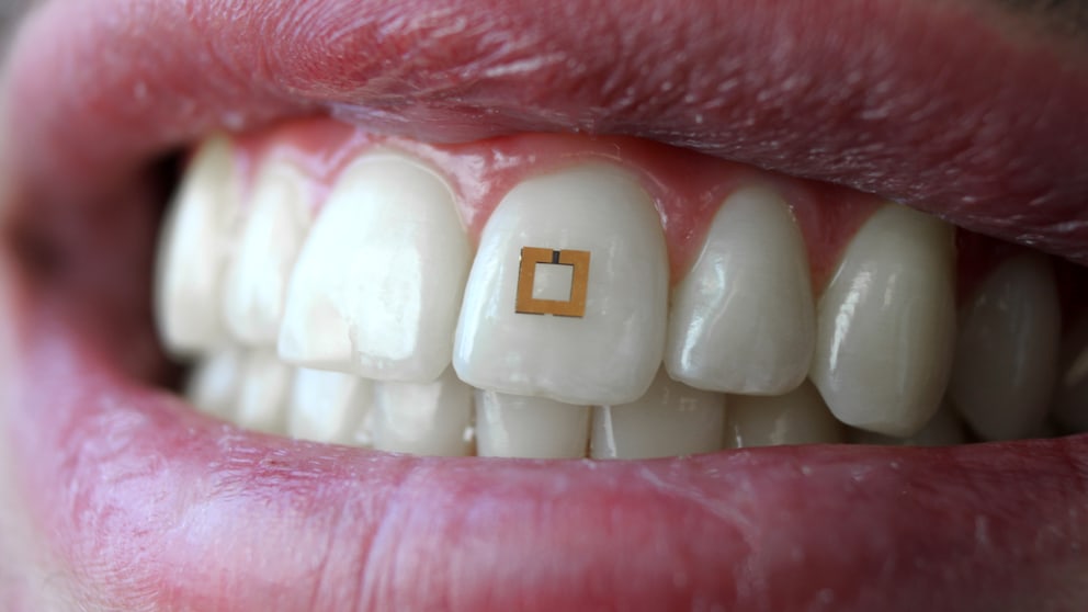 Bioanalyse-Chip auf einem Zahn