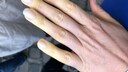 Finger mit Raynaud-Syndrom