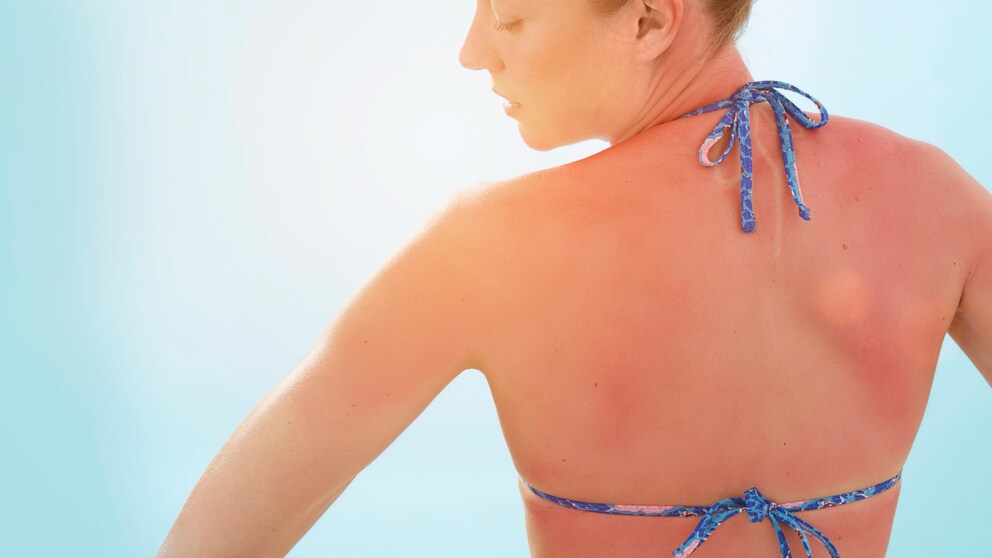 Frau mit Sonnenbrand