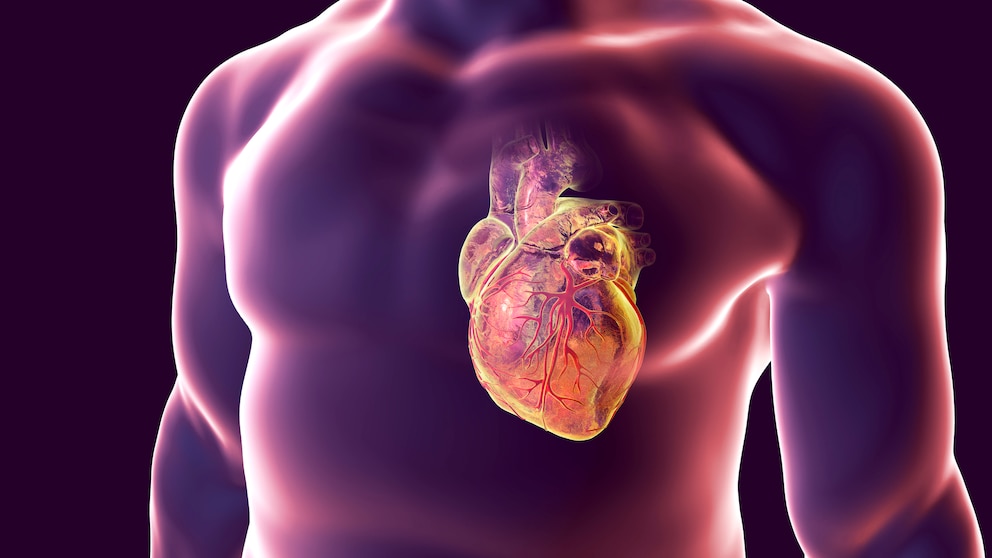 Menschliches Herz bei einem Herzinfarkt