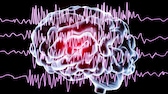 Gehirnströmungen bei epileptischem Anfall