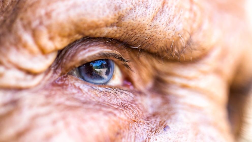Beim Grauen Star trübt sich die Linse – eine typische Augenerkrankung im Alter
