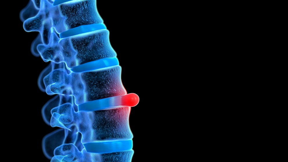 Bandscheibenvorfall: Illustration