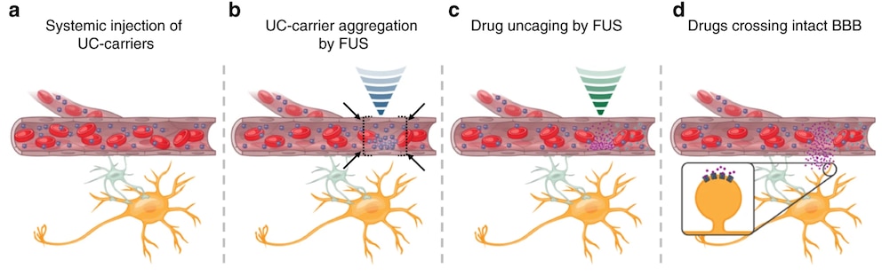 Ultraschall Medikamente: Illustration der Methode, mit Ultraschall Medikamente ins Gehirn zu bringen