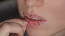 Skin Picking