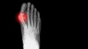 Röntgenbild eines Hallux valgus. Ob und wie er und andere Fußfehlstellungen behandelt werden muss, lesen Sie hier.