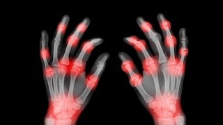 Mausarm – Ursachen, Diagnose, schmerzlindernde Übungen
