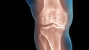 Knieschmerzen: Arthrose