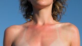 Frau mit Sonnebrand auf der Brust.