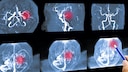 Astrazeneca Hirnthrombosen MRT-Scan