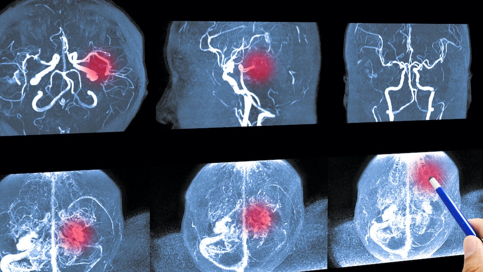 Astrazeneca Hirnthrombosen MRT-Scan