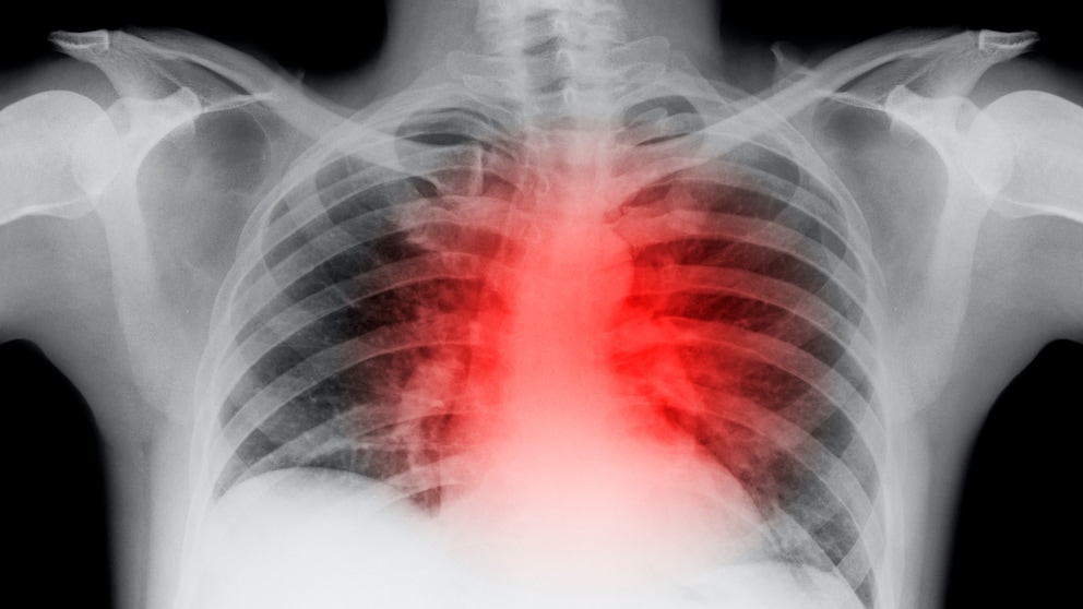 Aktivität und Herzinfarkt: Röntgenbild einer Herzattacke