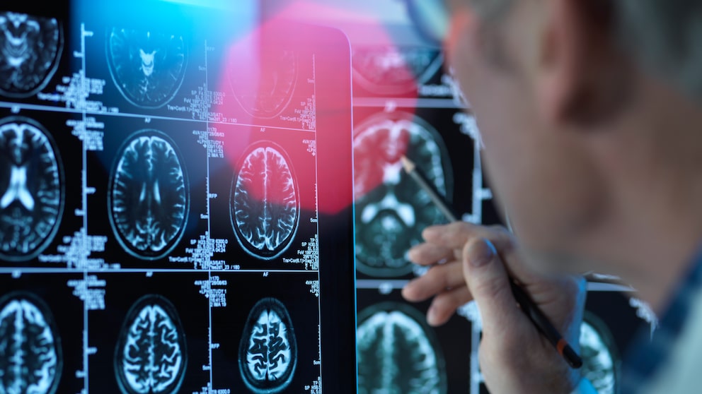 Seltene Form von Alzheimer: Arzt prüft Gehirn-Scans