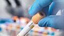 Blutprobe für Hepatitis-Test