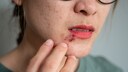 Herpes Demenz: