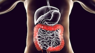 Die Erkrankung Colitis ulcerosa breitet sich im Dickdarm eines Menschen aus