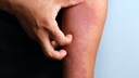 Neurodermitis: Was hilft?