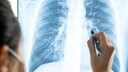 Coronavirus Lunge: R&ouml;ntgenbild der Lunge eines Covid-19-Patienten