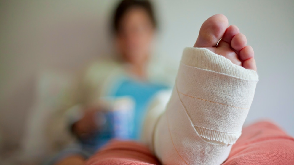 Knochenbrüche schneller heilen: Frau mit gebrochenem Bein