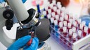 HIV Variante: Mikroskopische Untersuchung einer Blutprobe