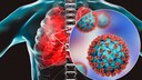 Heparin Lungenschäden Covid: Lunge mit Corona-Virus