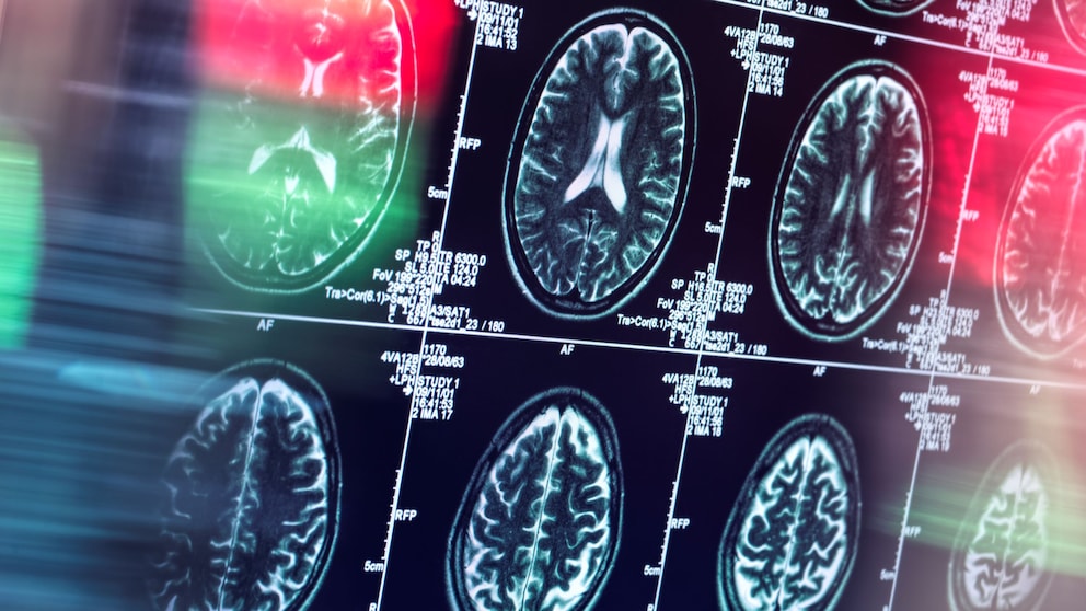 Was passiert beim Sterben im Gehirn? Diese Frage beschäftigt nicht nur Forscher