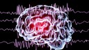 Computerillustration eines Gehirns mit neuronalen Störungen
