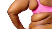 fettleibigkeit behandeln: Frau mit Speckrollen