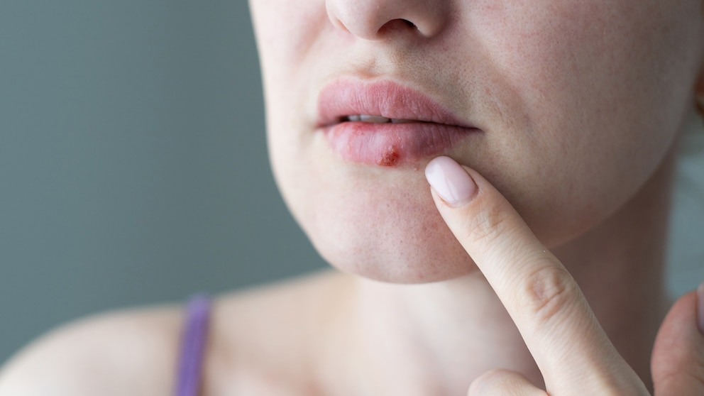 Lippenherpes schnell loswerden: Frau mit Lippenherpes fasst sich mit dem Finger an die Lippen.