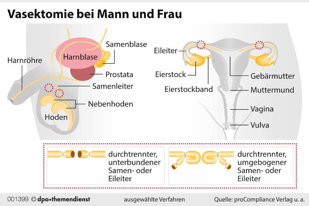 Sterilisation bei Mann und Frau