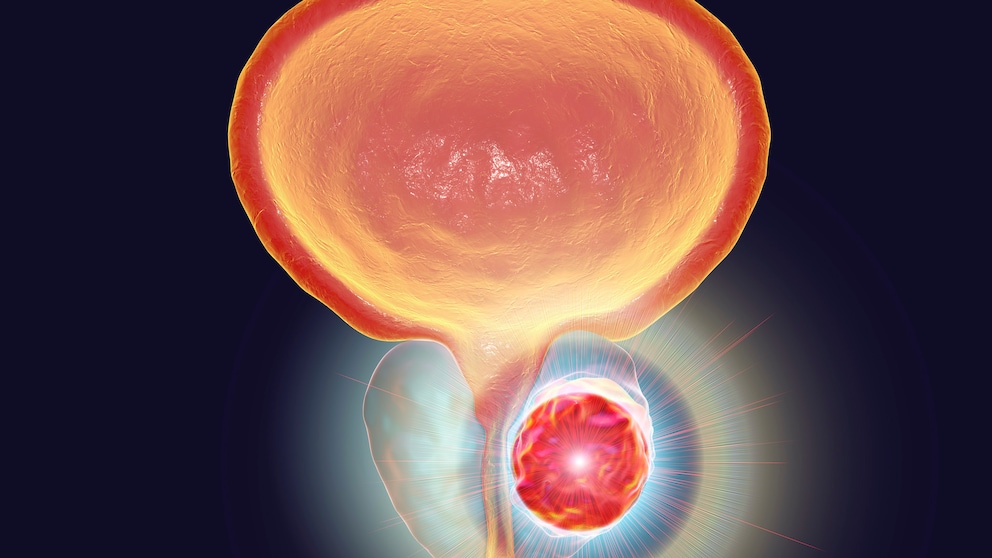 rauchen sterberisiko prostatakrebs: Illustration von Prostatakrebs