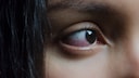 Symptome Augengrippe: rotes Auge