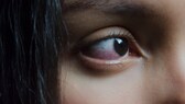 Symptome Augengrippe: rotes Auge