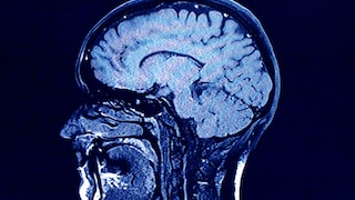 Parkinson Albträume: Gehirn Scan