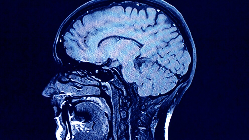 Parkinson Albträume: Gehirn Scan
