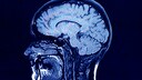 Parkinson Albtr&auml;ume: Gehirn Scan