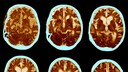 alzheimer corona: Scan von einem Gehirn eines Alzheimer-Patienten