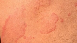 Nesselsucht verusacht Hautreaktionen, die Betroffene zunächst sehr erschrecken. Wie kommt es dazu? 