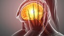 diagnose fibromyalgie: Illustration einer Frau. mit Kopfschmerzen