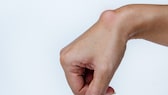 Ganglion: Überbein am Handgelenk