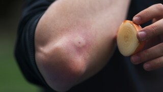 Mückenstich was hilft: Person hält Zwiebel an Mückenstich
