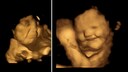 Babys im Mutterbauch (4D Scan)