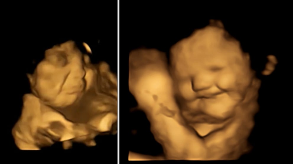 Babys im Mutterbauch (4D Scan)