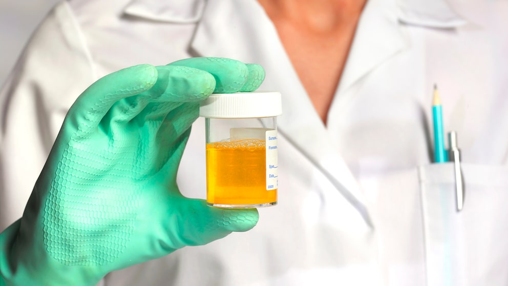 Mediziner in weißem Kittel hält Urinprobe in der Hand
