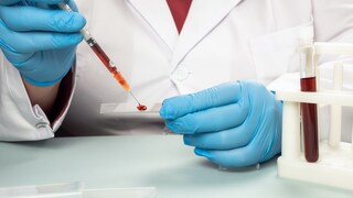 blutgruppe schlaganfallrisiko: Blutanalyse