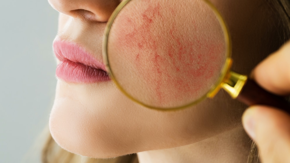 rosacea: Frau mit Rötungen im Gesicht