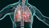 risikofaktor lungenkrebs: Illustration von Lungenkrebs