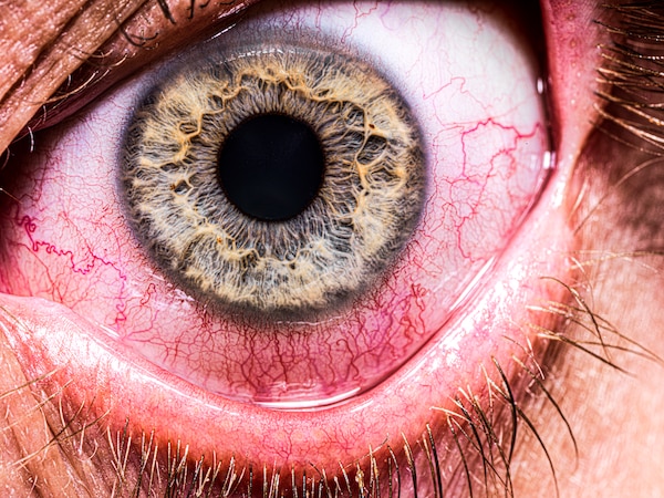 Blutrot unterlaufene Augen sind ein Warnsignal, das einen Arztbesuch dringend nötig macht