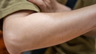 hautabstrich Parkinson diagnostizieren: Ein Arm